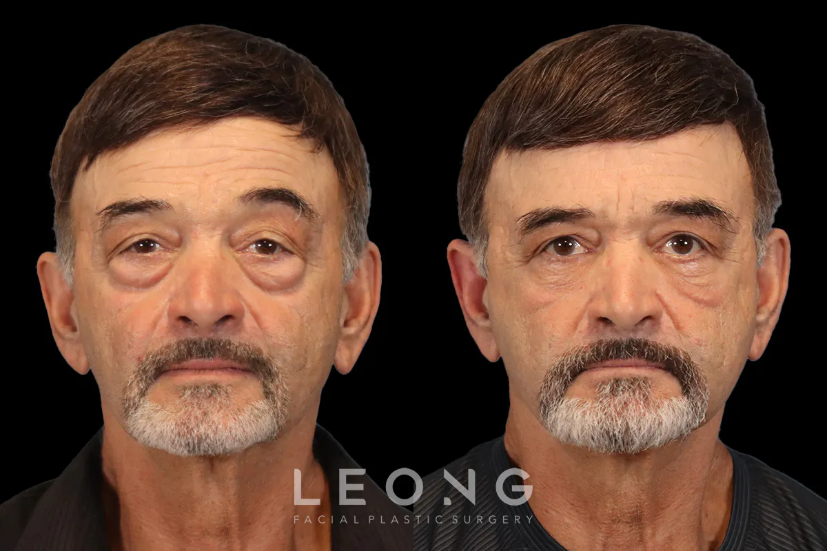 Blepharoplasty Before and After | Leong Facial Plastic Surgery