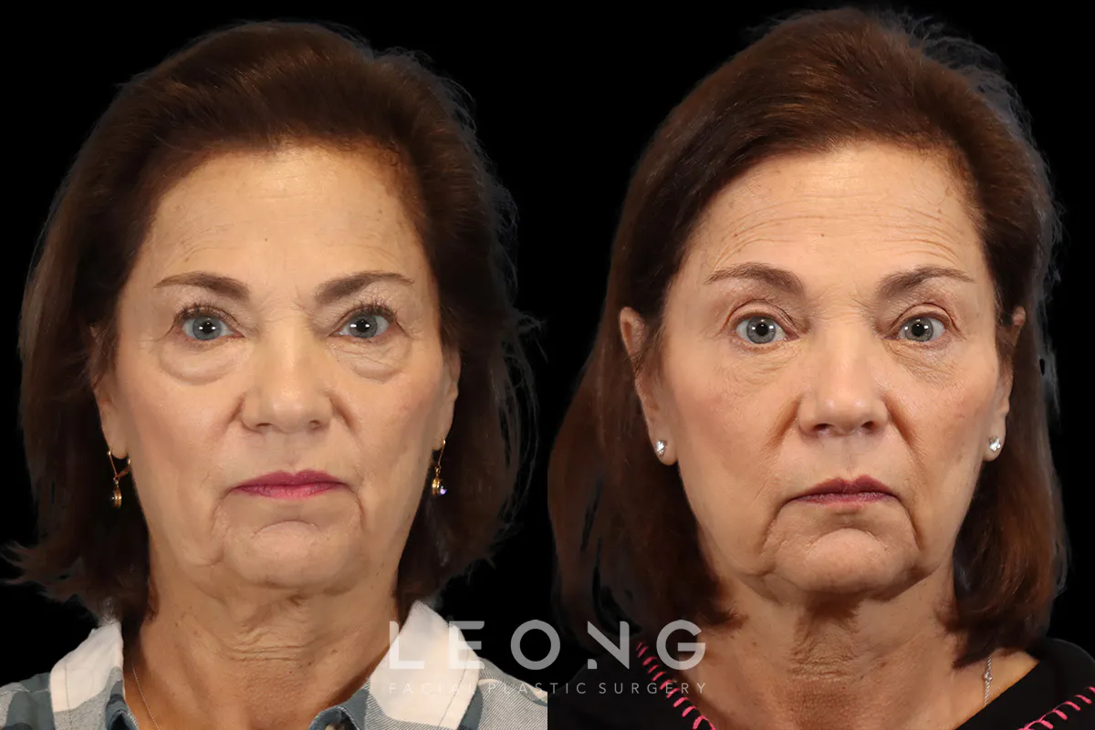 Blepharoplasty Before and After | Leong Facial Plastic Surgery