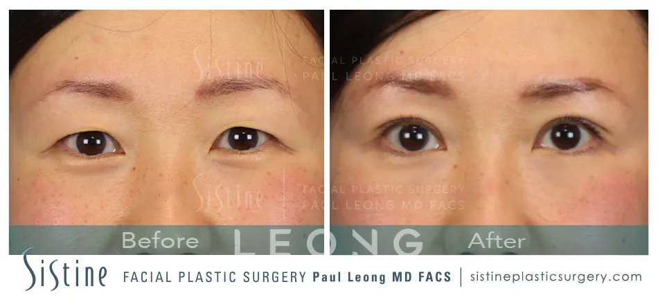 Blepharoplasty Before and After | Leong Facial Plastic Surgery