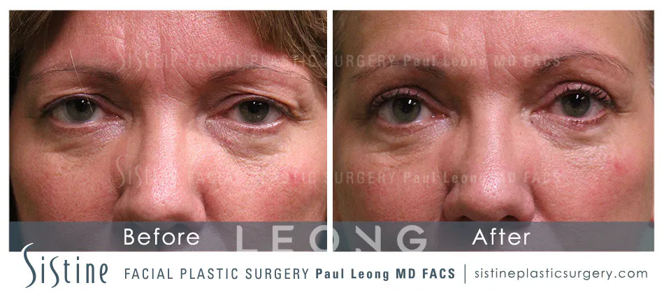 Blepharoplasty Before and After | Leong Facial Plastic Surgery