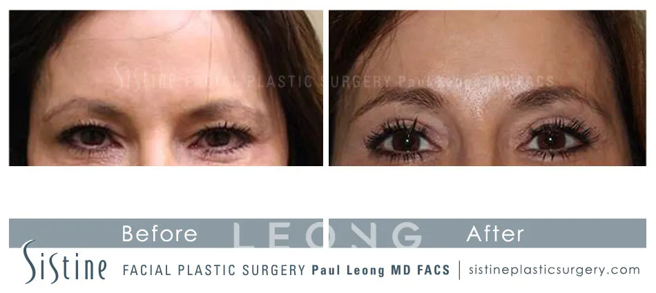 Blepharoplasty Before and After | Leong Facial Plastic Surgery