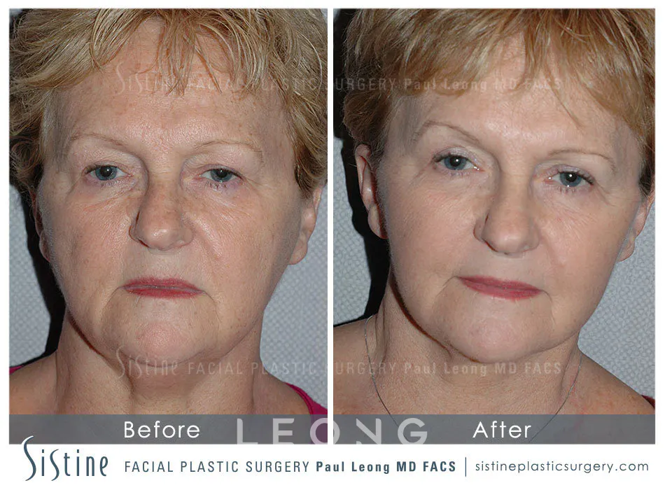 Blepharoplasty Before and After | Leong Facial Plastic Surgery