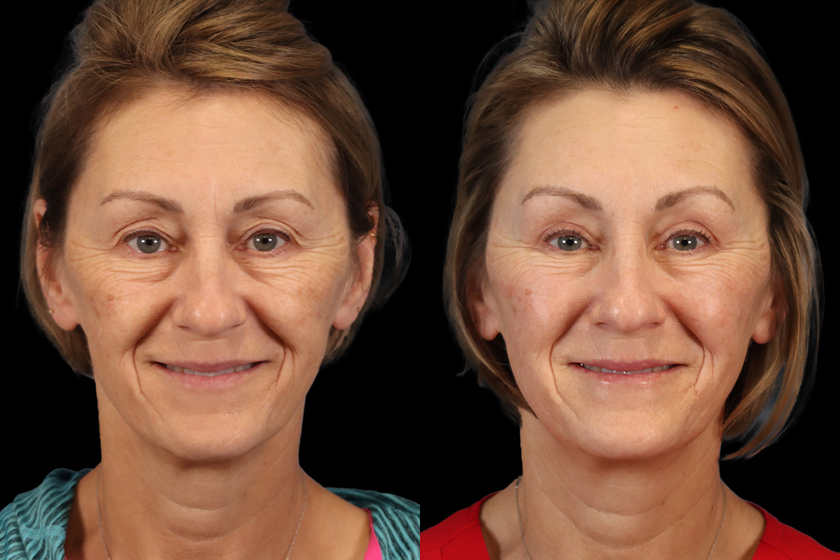 Blepharoplasty Before and After | Leong Facial Plastic Surgery