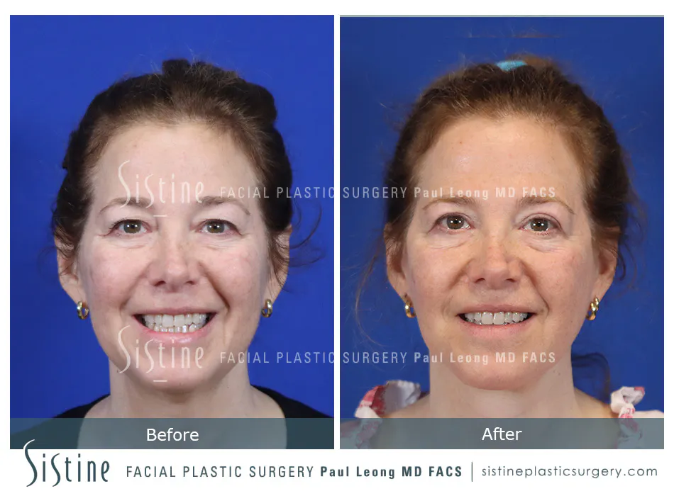 Blepharoplasty Before and After | Leong Facial Plastic Surgery