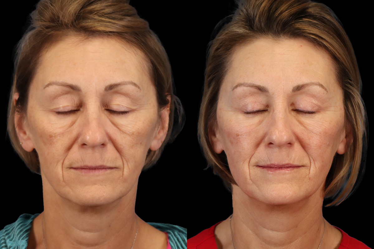 Blepharoplasty Before and After | Leong Facial Plastic Surgery