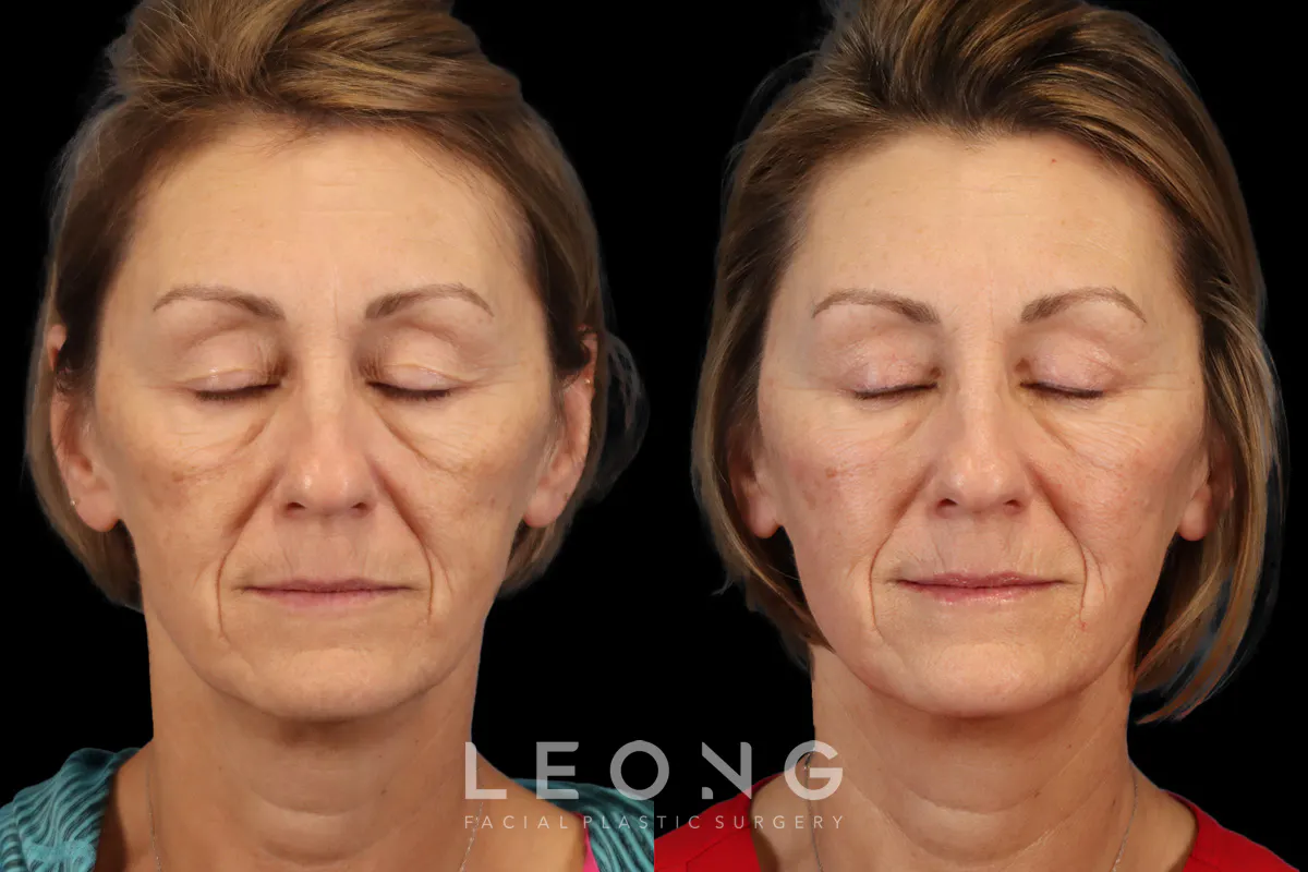 Blepharoplasty Before and After | Leong Facial Plastic Surgery