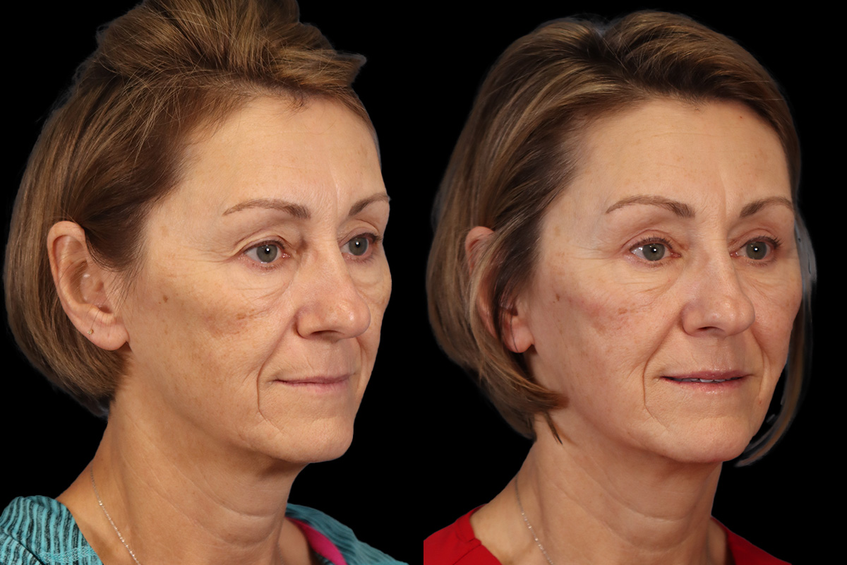 Blepharoplasty Before and After | Leong Facial Plastic Surgery