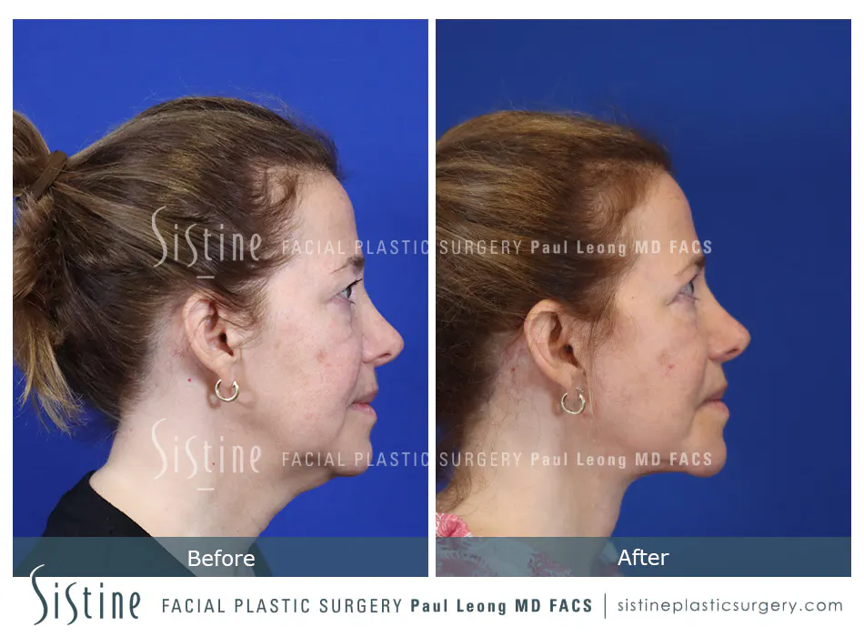 Blepharoplasty Before and After | Leong Facial Plastic Surgery