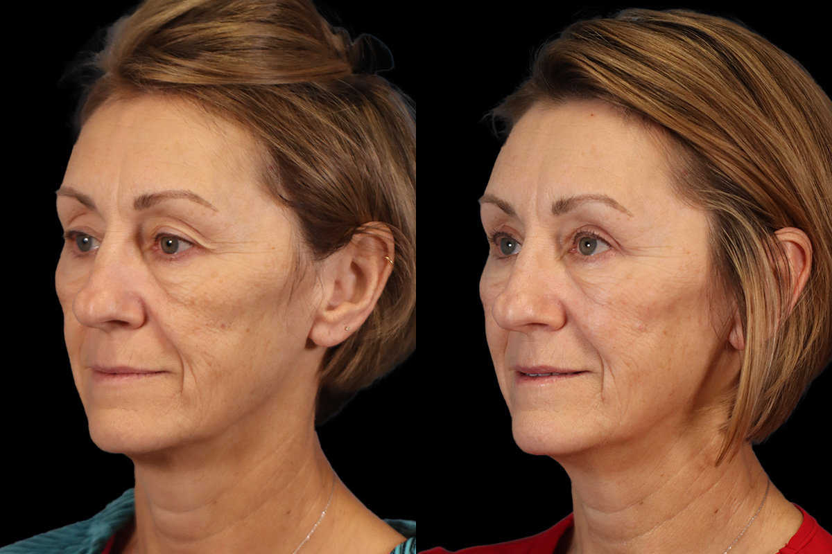 Blepharoplasty Before and After | Leong Facial Plastic Surgery