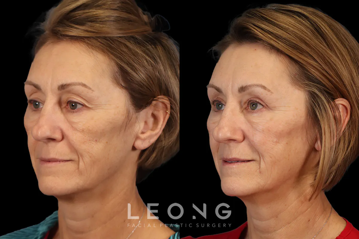 Blepharoplasty Before and After | Leong Facial Plastic Surgery