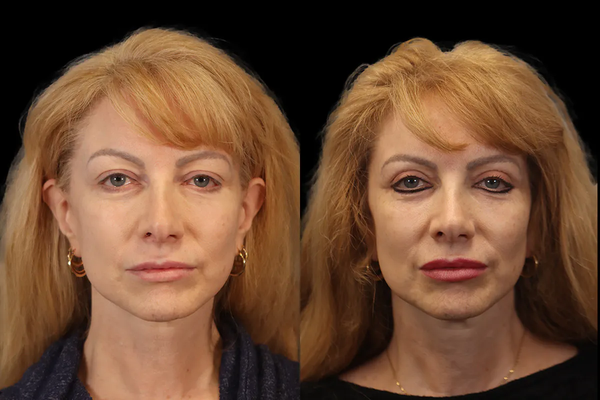 Blepharoplasty Before and After | Leong Facial Plastic Surgery