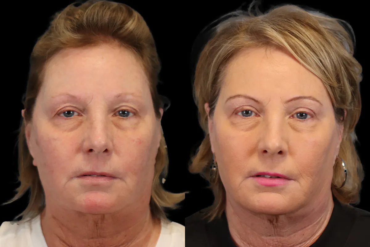 Blepharoplasty Before and After | Leong Facial Plastic Surgery