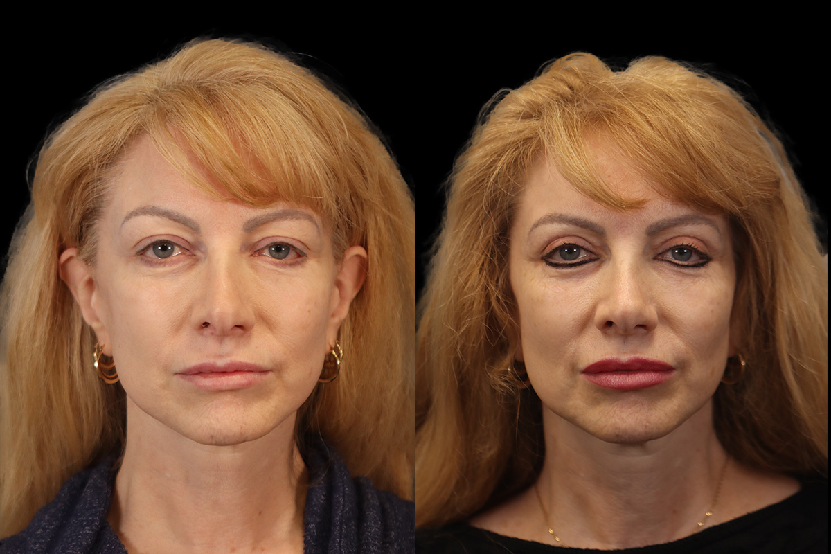 Blepharoplasty - Preoperative View | Sistine Facial Plastic Surgery