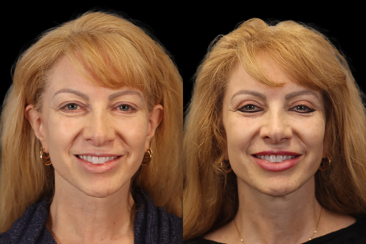 Blepharoplasty - Preoperative View | Sistine Facial Plastic Surgery