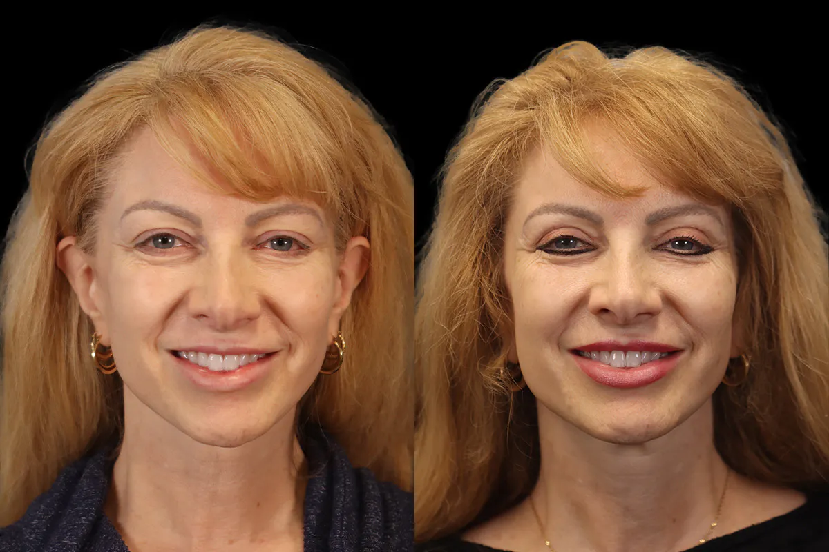 Blepharoplasty Before and After | Leong Facial Plastic Surgery