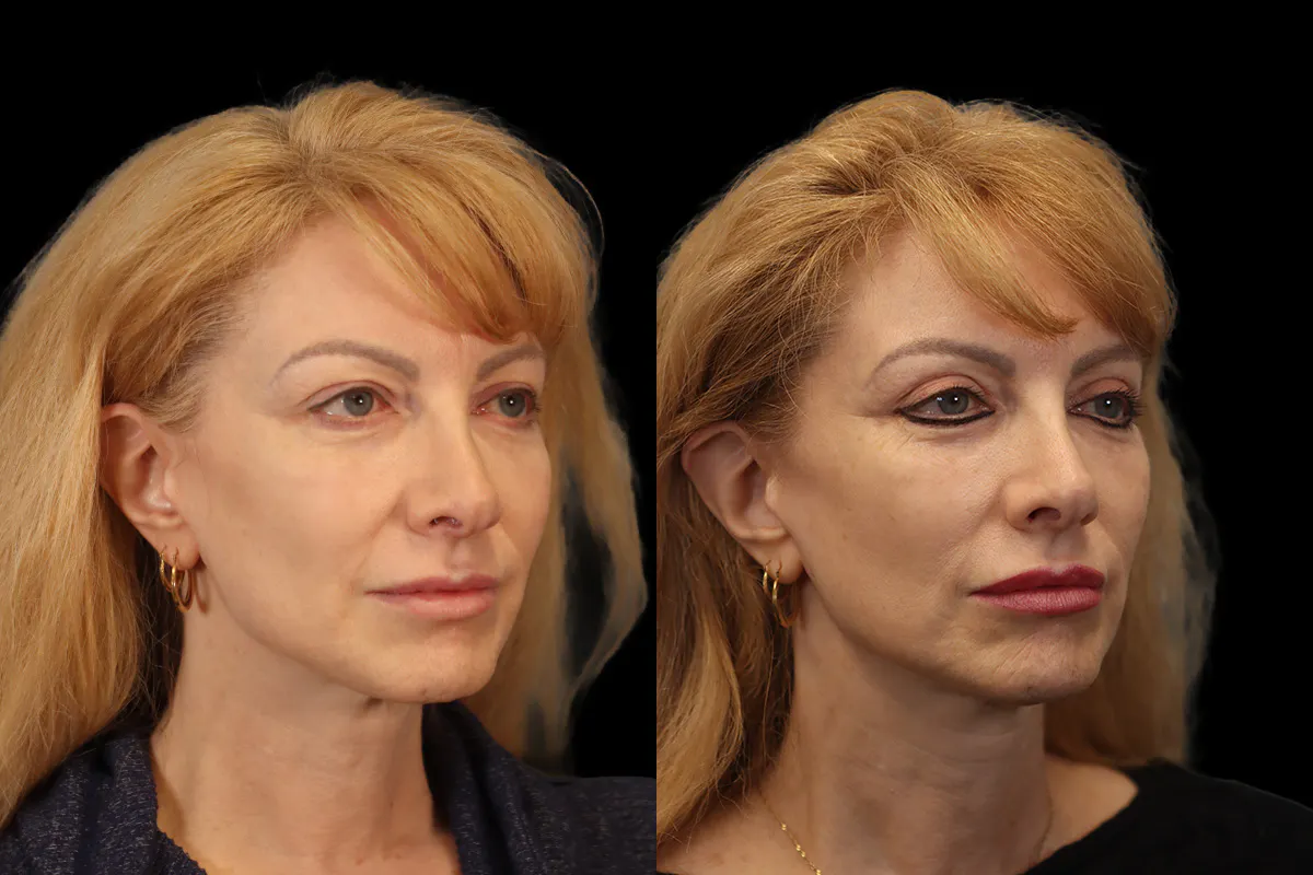 Blepharoplasty Before and After | Leong Facial Plastic Surgery