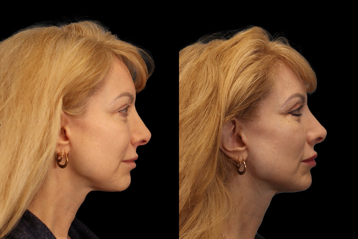 Blepharoplasty - Preoperative View | Sistine Facial Plastic Surgery