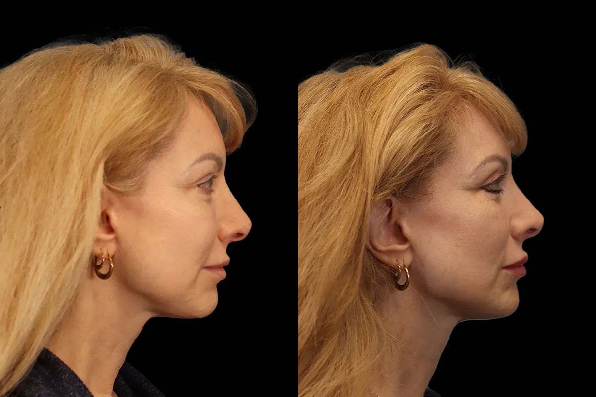 Blepharoplasty Before and After | Leong Facial Plastic Surgery