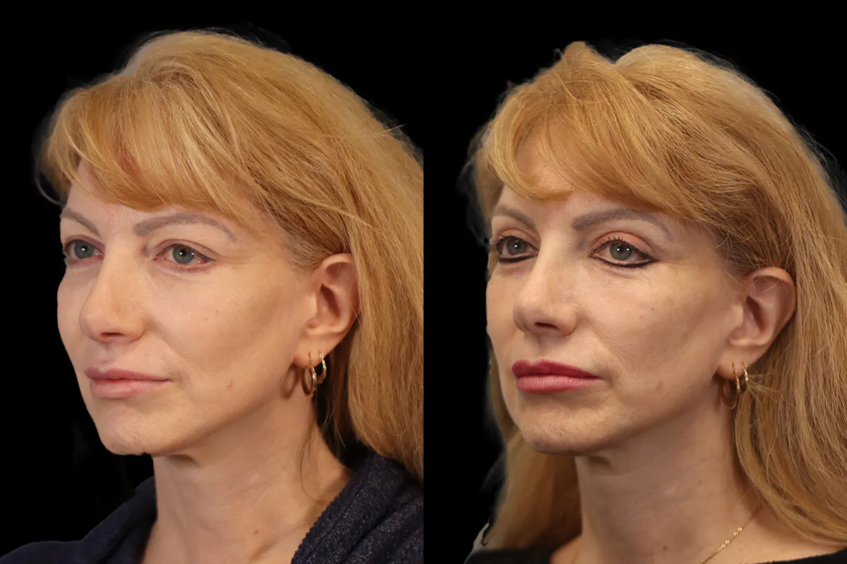 Blepharoplasty Before and After | Leong Facial Plastic Surgery