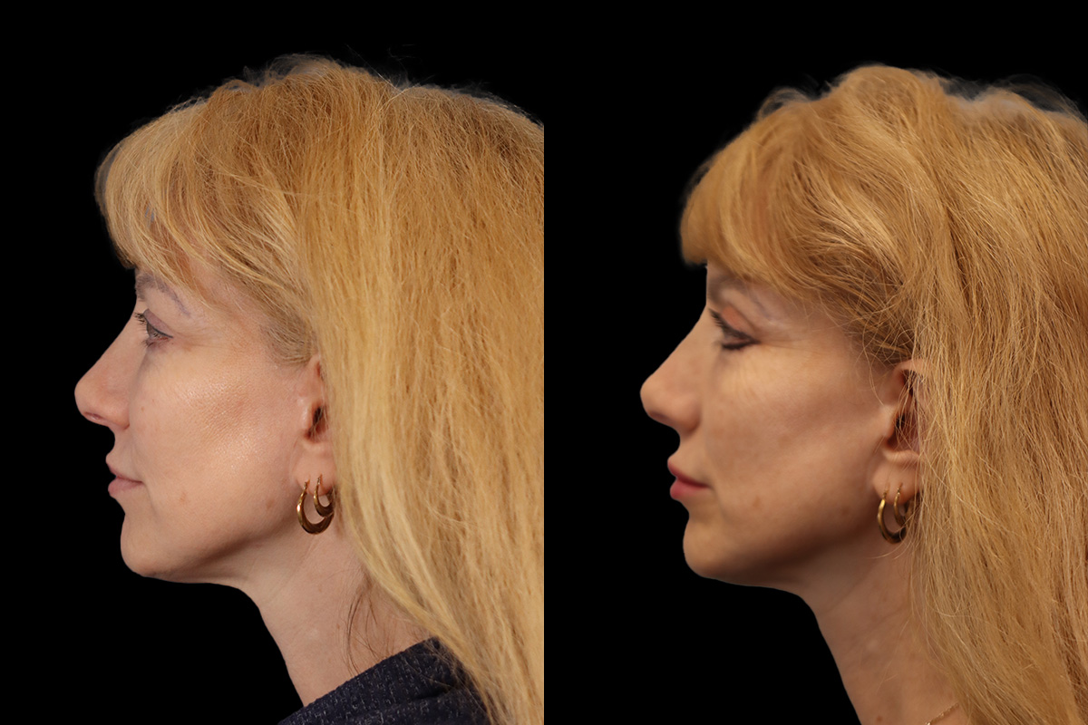 Blepharoplasty - Preoperative View | Sistine Facial Plastic Surgery