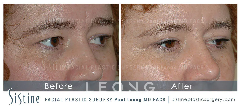 Blepharoplasty Before and After | Leong Facial Plastic Surgery
