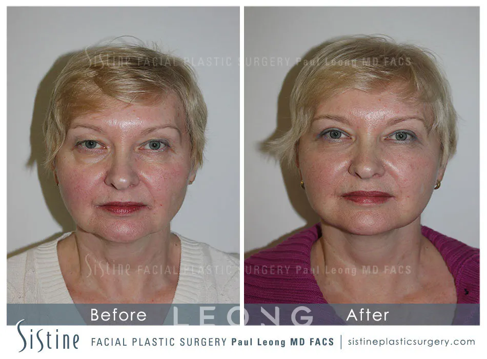 Blepharoplasty Before and After | Leong Facial Plastic Surgery