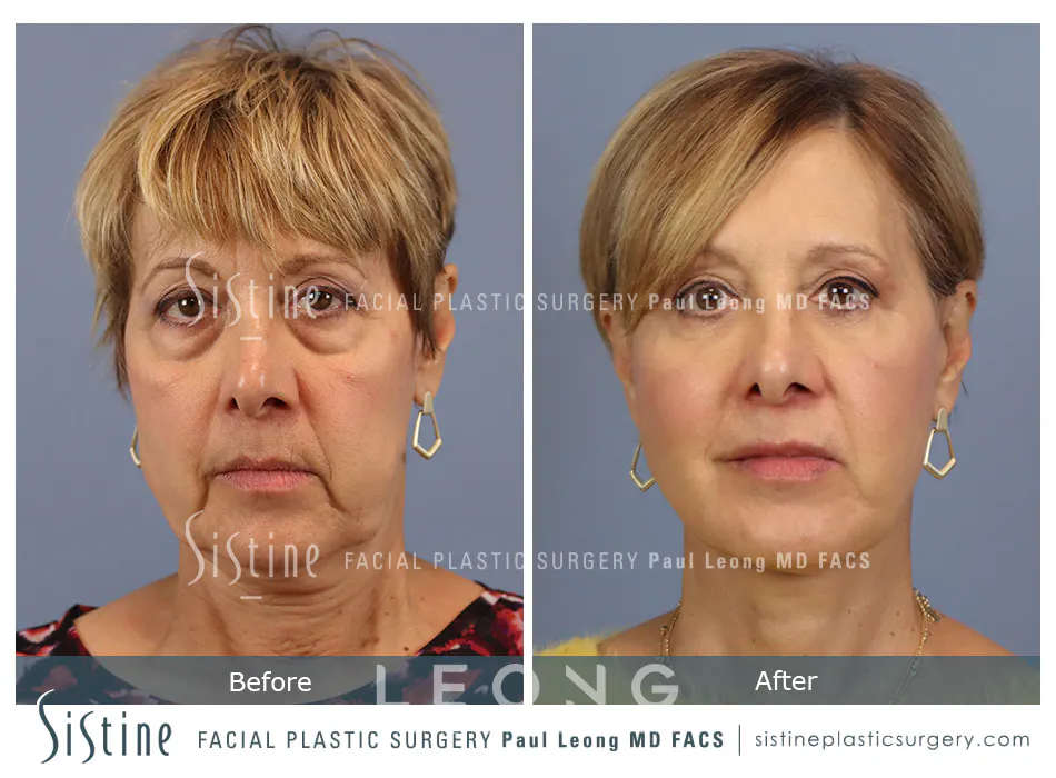 Blepharoplasty Before and After | Leong Facial Plastic Surgery