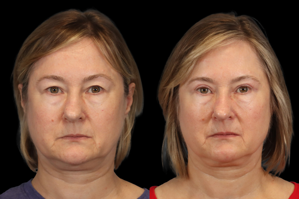 Blepharoplasty Before and After | Leong Facial Plastic Surgery