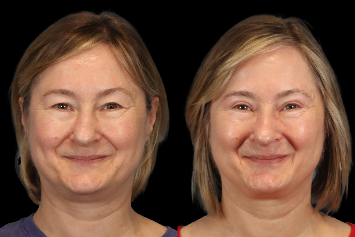 Blepharoplasty Before and After | Leong Facial Plastic Surgery