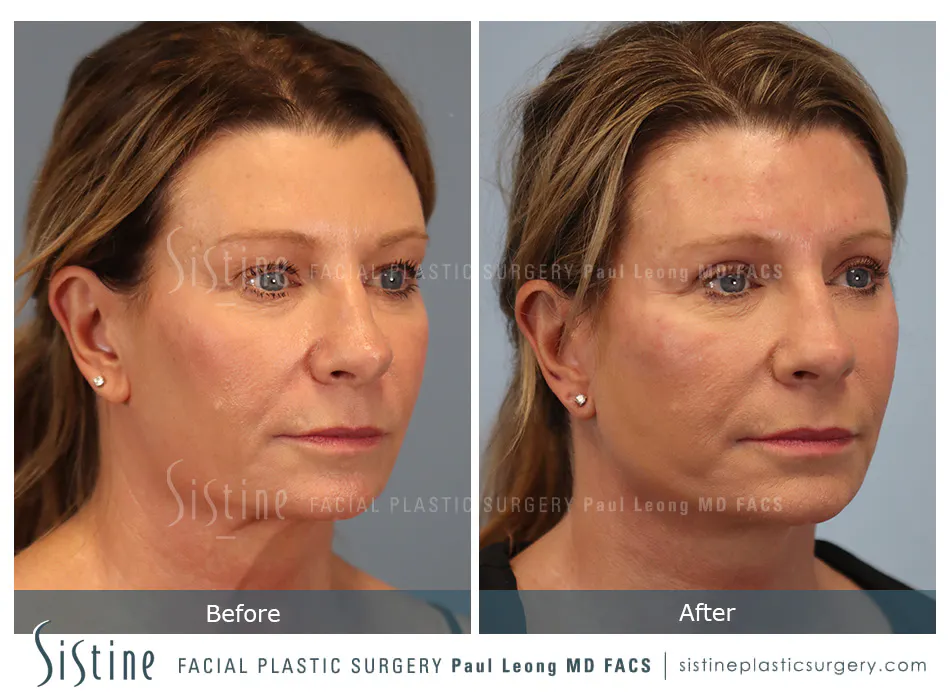 Blepharoplasty Before and After | Leong Facial Plastic Surgery