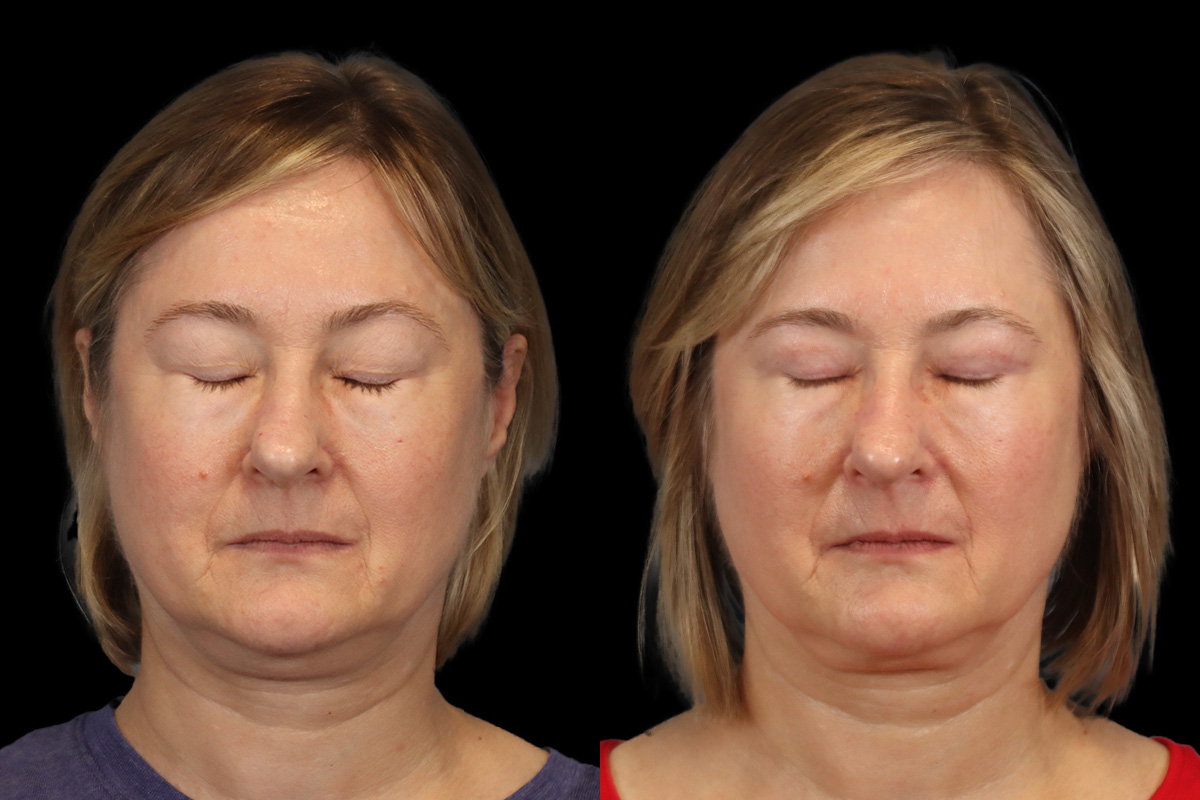 Blepharoplasty Before and After | Leong Facial Plastic Surgery