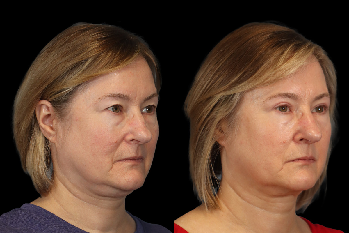 Blepharoplasty Before and After | Leong Facial Plastic Surgery