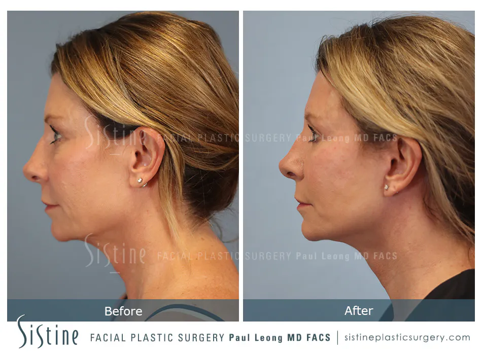 Blepharoplasty Before and After | Leong Facial Plastic Surgery