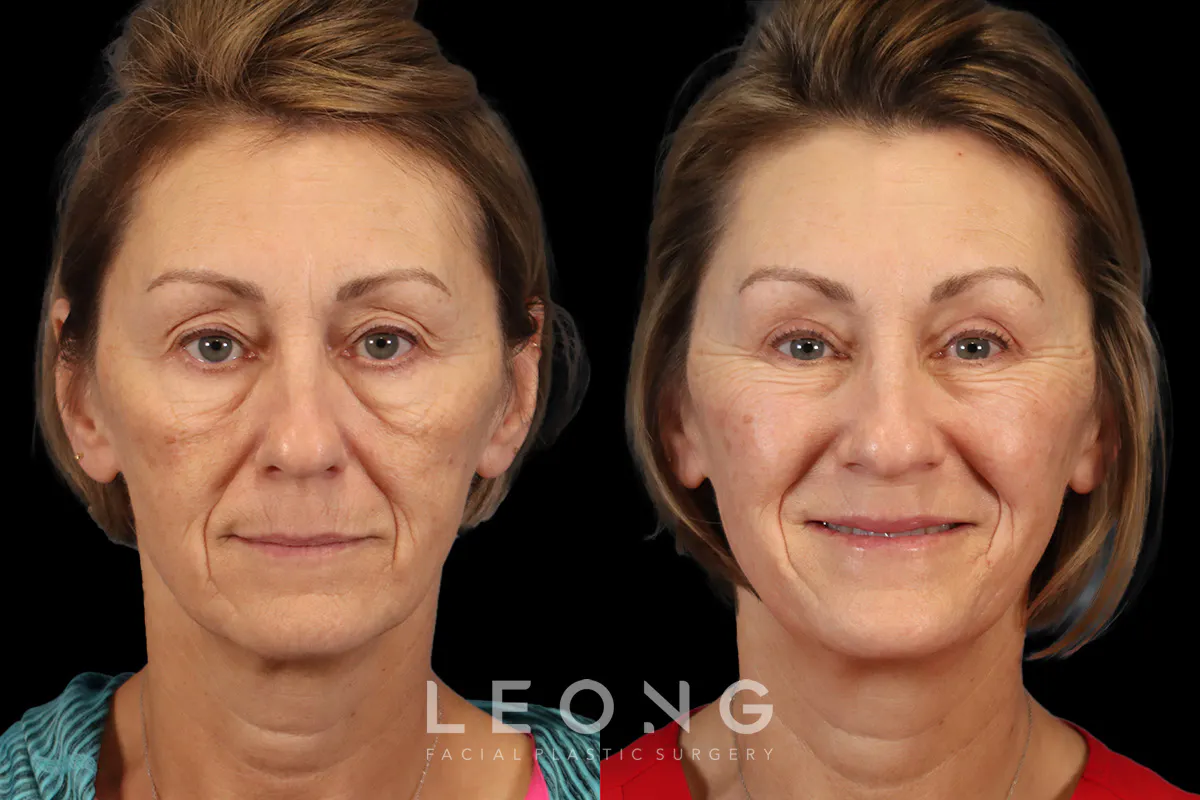 Blepharoplasty Before and After | Leong Facial Plastic Surgery