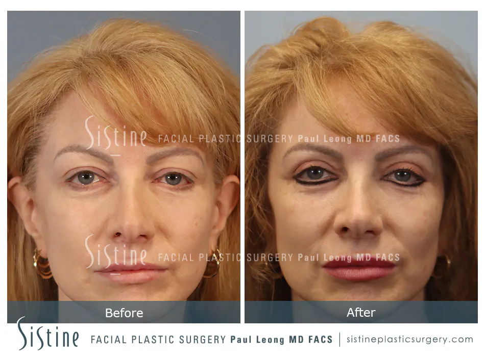 Blepharoplasty Before and After | Leong Facial Plastic Surgery