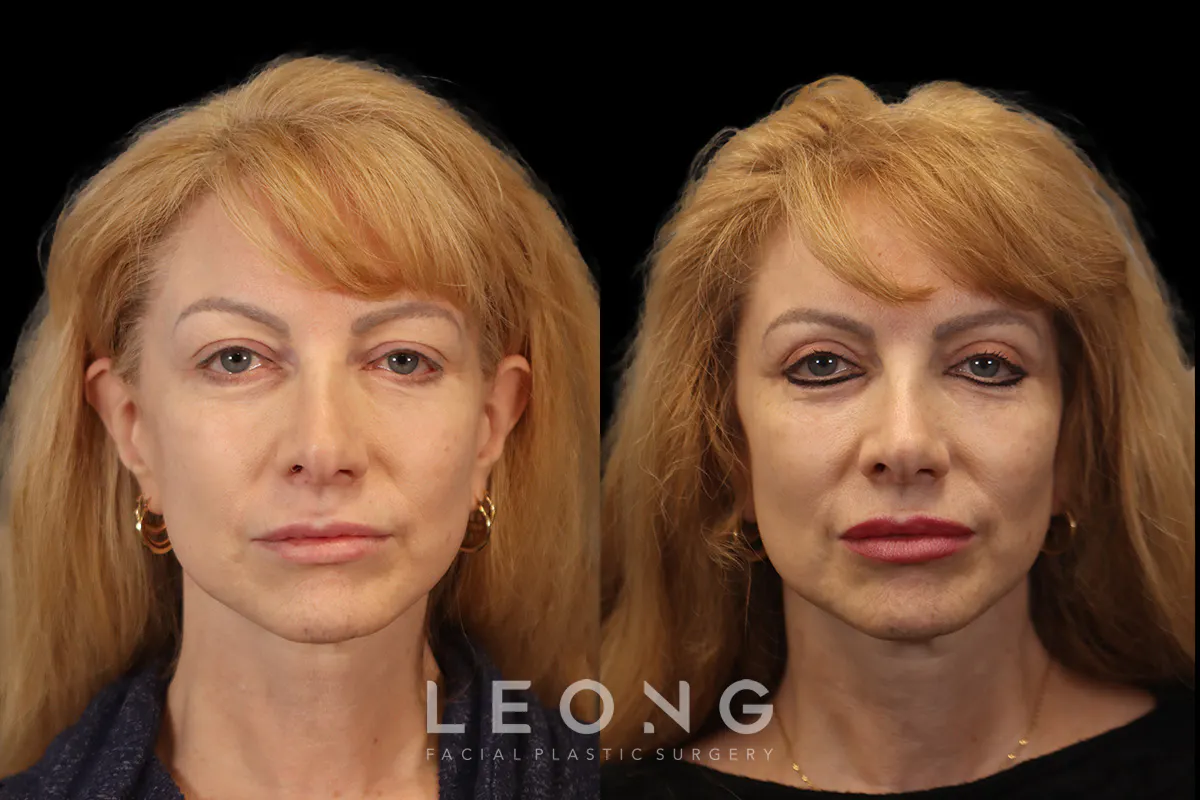 Blepharoplasty Before and After | Leong Facial Plastic Surgery