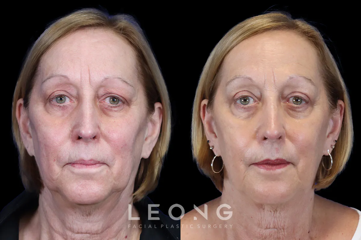 Blepharoplasty Before and After | Leong Facial Plastic Surgery