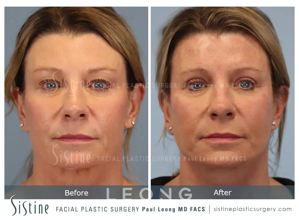 Blepharoplasty Before and After | Leong Facial Plastic Surgery