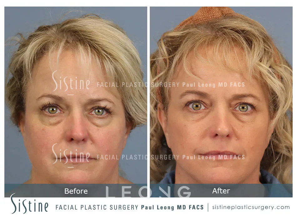 Blepharoplasty Before and After | Leong Facial Plastic Surgery