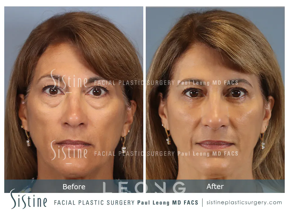 Blepharoplasty Before and After | Leong Facial Plastic Surgery