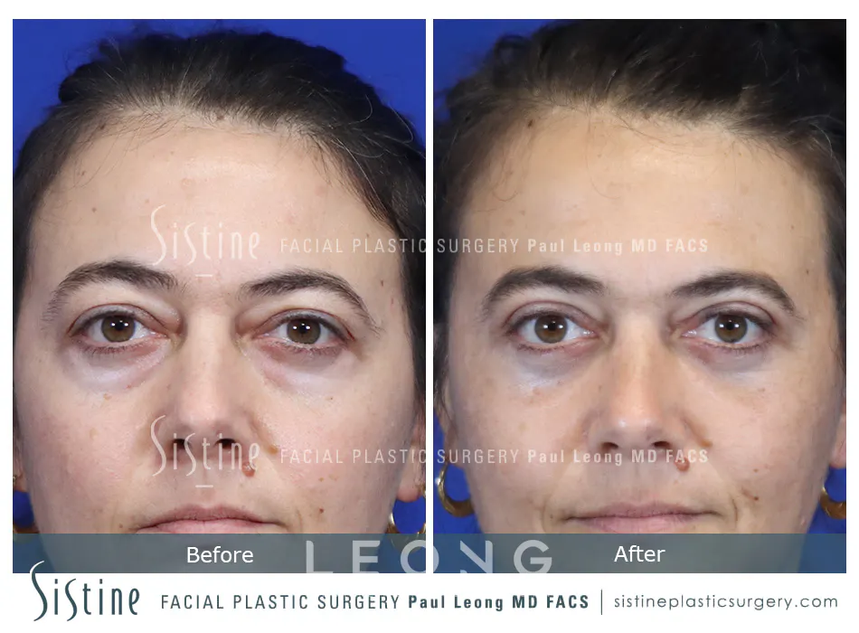 Blepharoplasty Before and After | Leong Facial Plastic Surgery