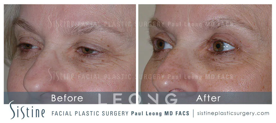 Blepharoplasty Before and After | Leong Facial Plastic Surgery