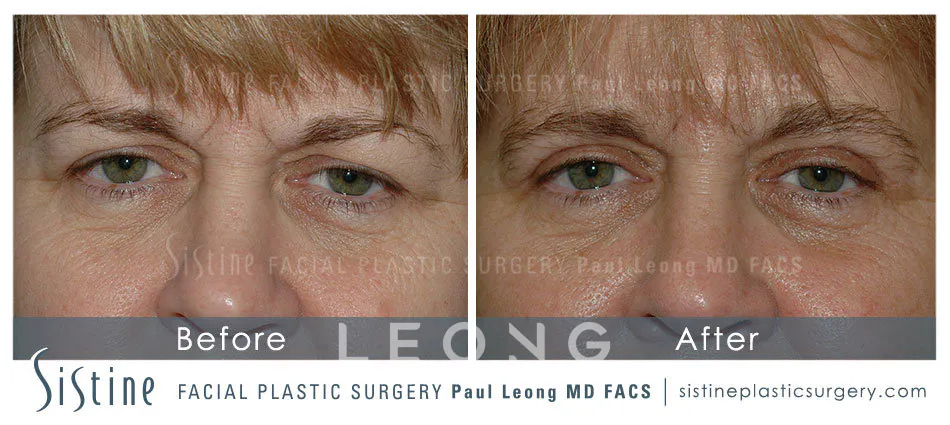 Blepharoplasty Before and After | Leong Facial Plastic Surgery