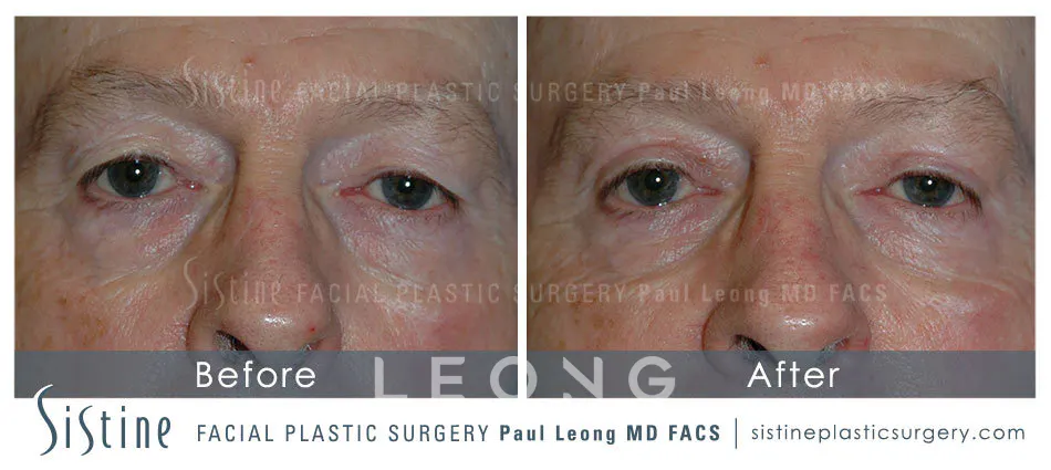 Blepharoplasty Before and After | Leong Facial Plastic Surgery
