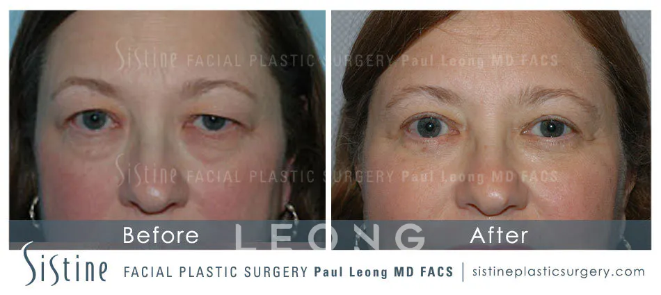Blepharoplasty Before and After | Leong Facial Plastic Surgery
