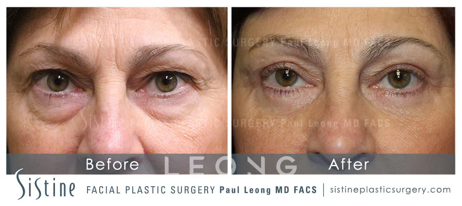 Blepharoplasty Before and After | Leong Facial Plastic Surgery