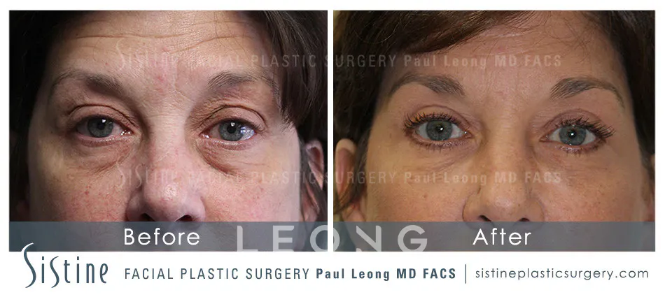 Blepharoplasty Before and After | Leong Facial Plastic Surgery