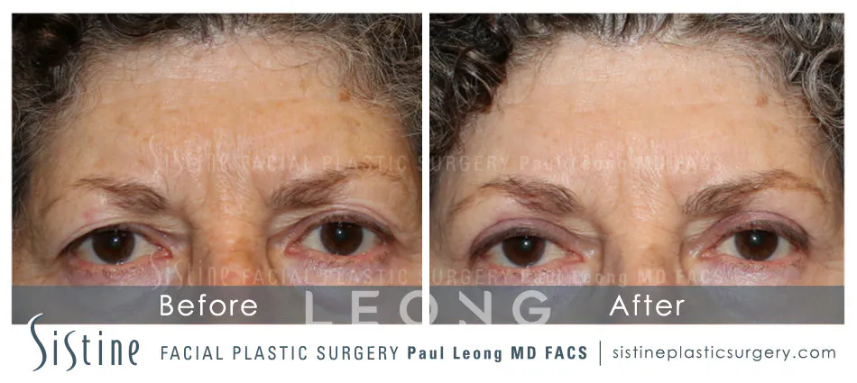 Blepharoplasty Before and After | Leong Facial Plastic Surgery