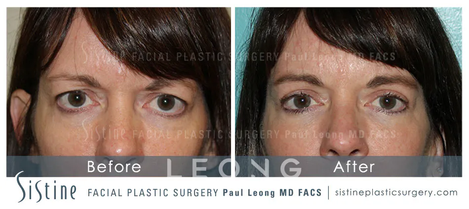 Blepharoplasty Before and After | Leong Facial Plastic Surgery