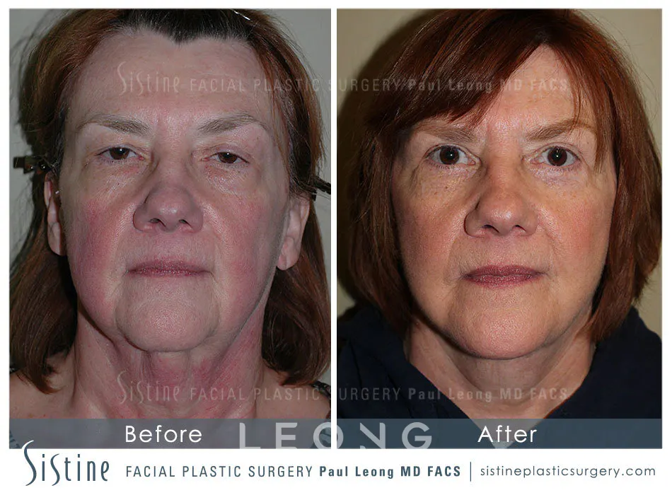 Blepharoplasty Before and After | Leong Facial Plastic Surgery